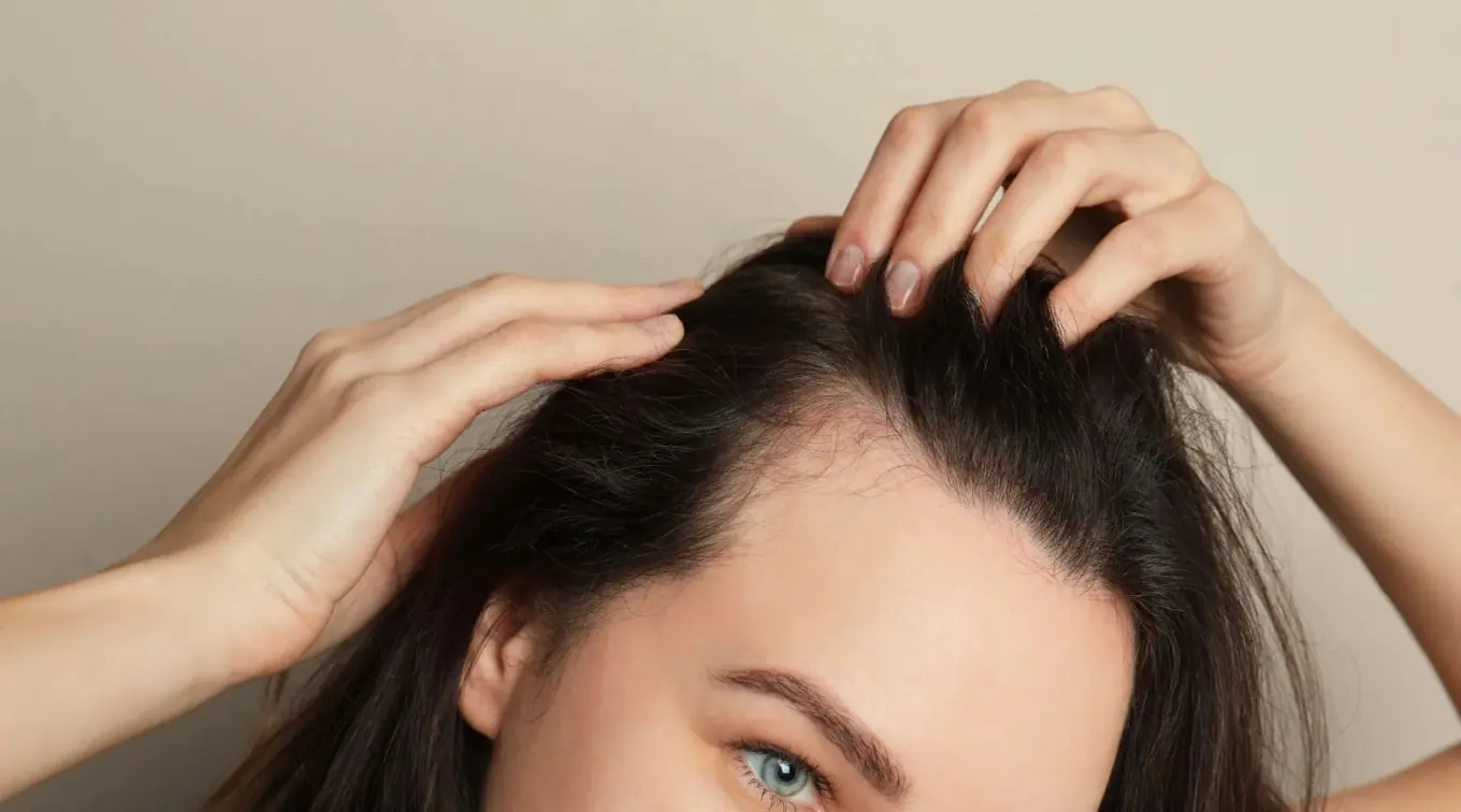 Alopecia